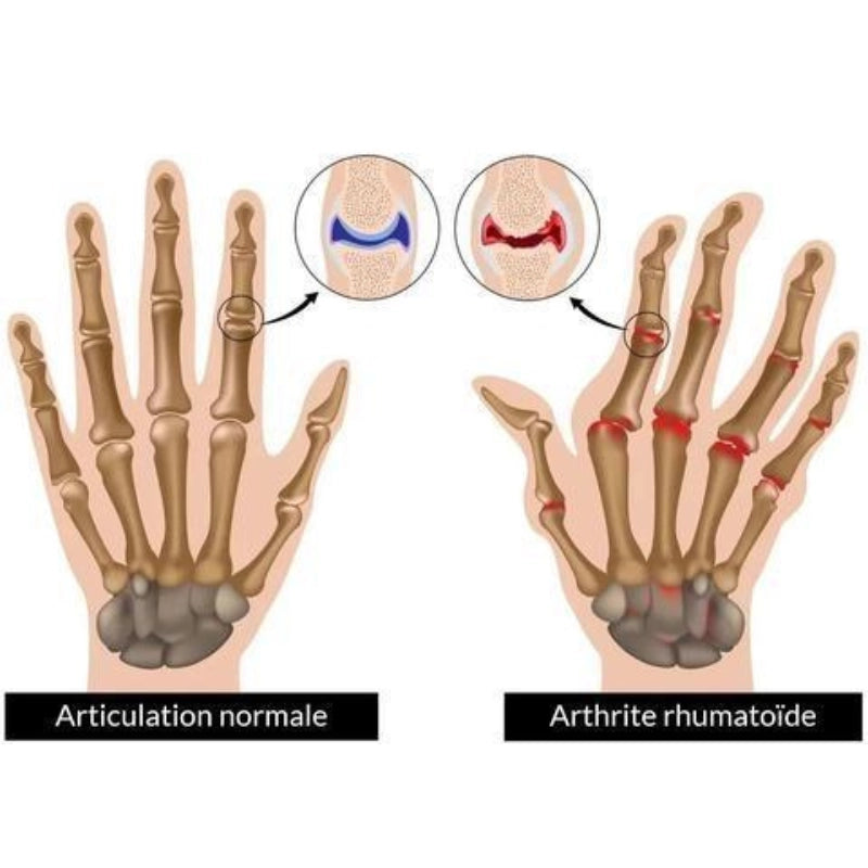 comparaison doigts normaux et doigts avec de l'arthrite
